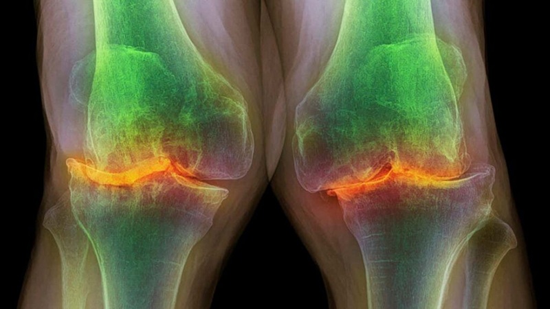 آرتروز؛ فرسودگی خاموش مفاصل که زندگی را محدود می‌کند! | بهترین متخصص ارتوپدی اصفهان | دکتر هادی ملاعباسی | جراحی بازسازی رباط صلیبی تحت بیهوشی عمومی